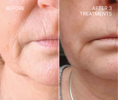 Lumenis triLift before and after 3 treatments