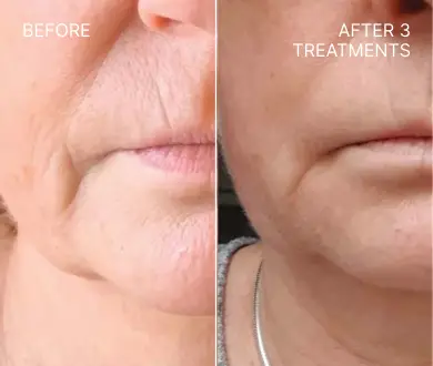 Lumenis triLift before and after 3 treatments