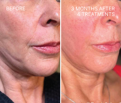 Lumenis triLift before and after 3months 4 treatments