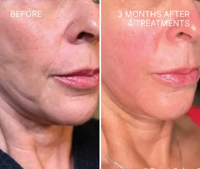 Lumenis triLift before and after 3months 4 treatments