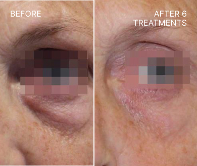 Lumenis triLift before and after 6 months