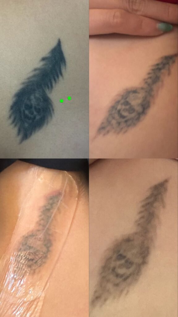 Tattoo Removal at Sage & Honey Wellness
