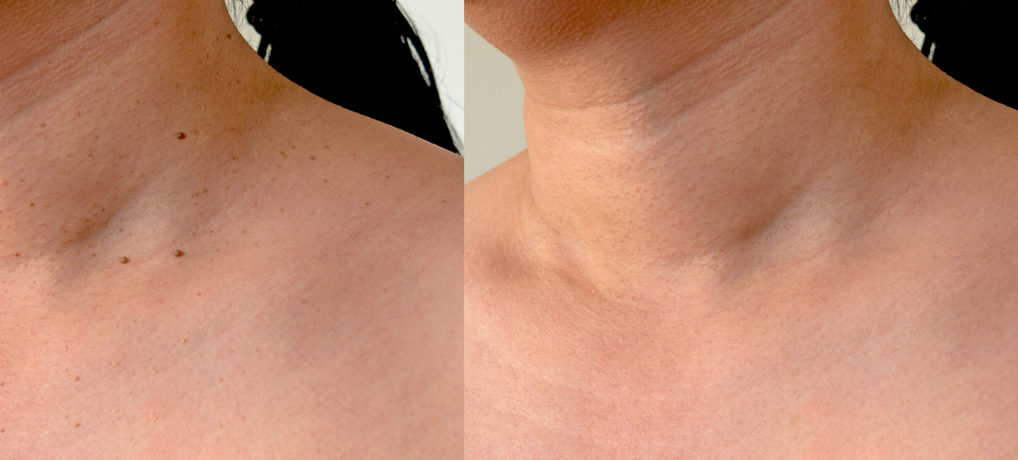 Sage & Honey Wellness Skin Tag Removal