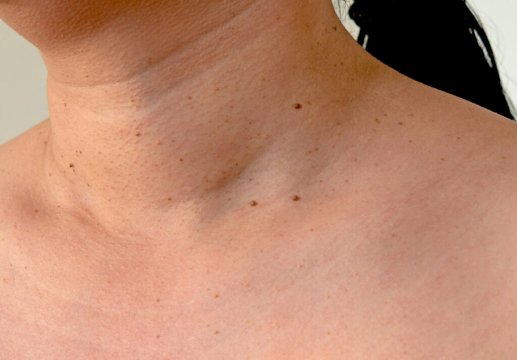 Sage & Honey Wellness Skin Tag Removal